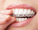 clear braces for teeth
