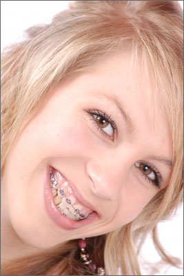 getting braces for straight teeth, better health