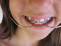 Medicaid orthodontic treatment in New Hampshire