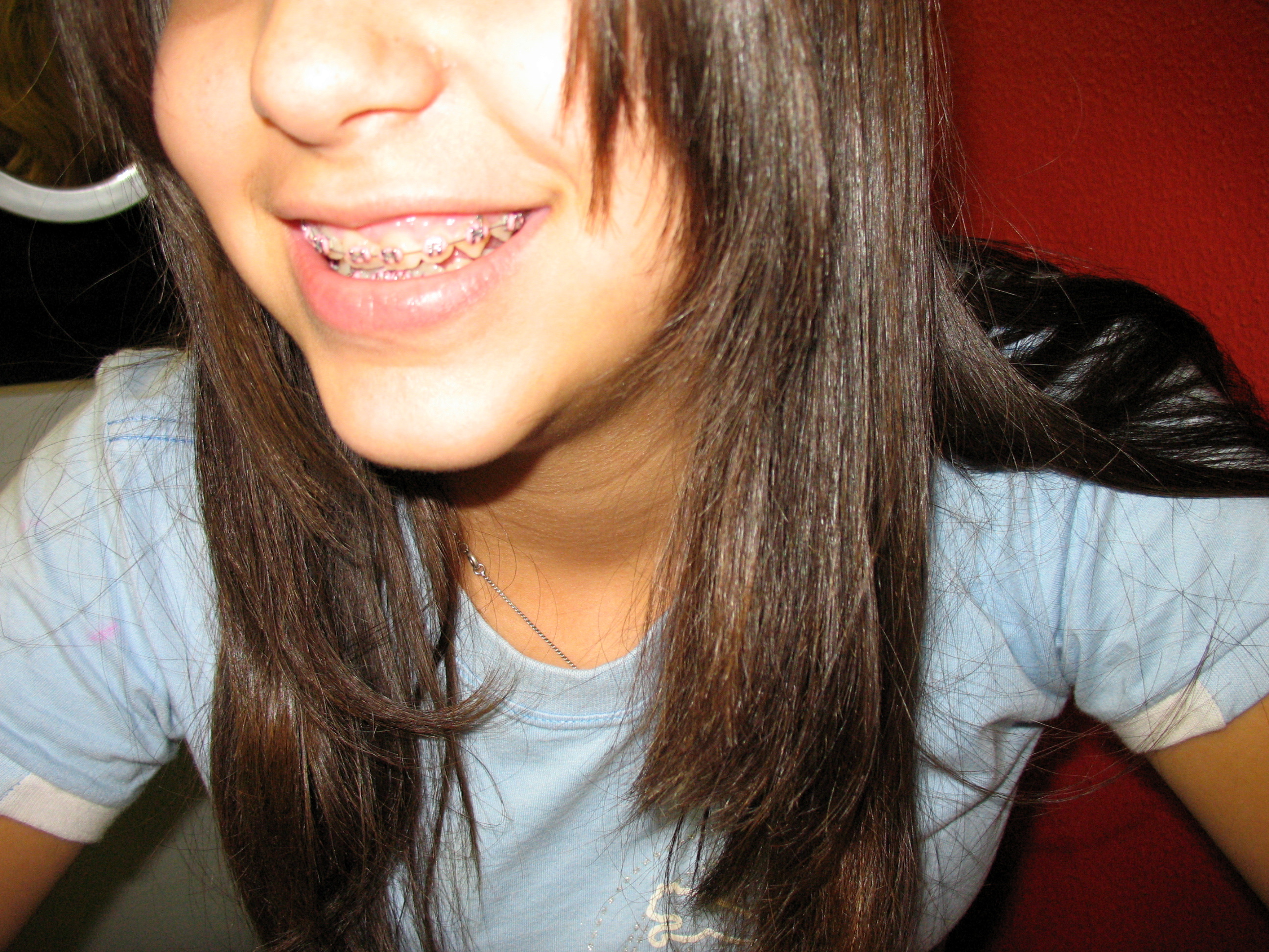 getting braces myths debunked